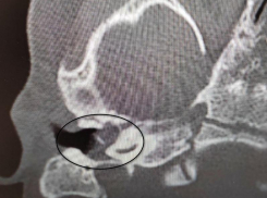 Врачи вылечили редкое заболевание у 2-летней девочки и сохранили ей слух