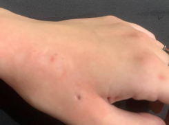 О нападении бездомной собаки на подростка рассказали в Воронеже