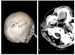 Хирурги спасли мужчину от инсульта в Воронеже