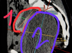 Почти пол-литра крови откачали из матки подростка в Воронеже