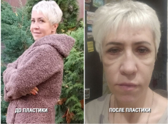 «Боюсь смотреть в зеркало»: пластическая операция превратила в кошмар жизнь воронежской пациентки