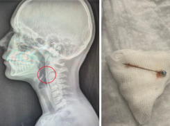 Во время развешивания гирлянды девочка проглотила иголку в Воронеже