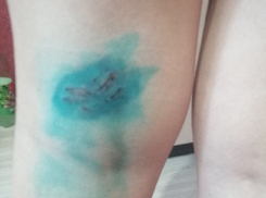 Собака с чипом на ухе прокусила ногу девочке в Воронеже