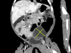 Новорождённую девочку с кистой в брюшной полости спасли медики в Воронеже