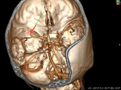 Стрессы на работе довели 35-летнюю женщину до инсульта в Воронеже 