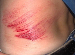 Асфальт поглотил жителя Воронежа, оставив жесткие следы