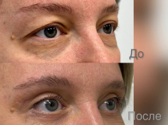 «Круговая» блефаропластика (верхняя+нижняя)  в клинике «Доктор Альбрехт»