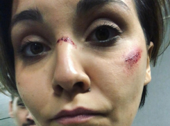 Разбитым лицом испугала поклонников звезда «Бара в большом городе»