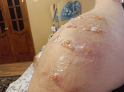 Многочисленными ожогами закончился поход на массаж у жительницы Воронежской области