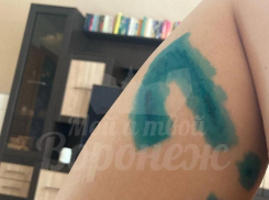 Последствия укуса бездомной собаки показала жительница Воронежа