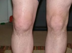 В Воронежской области мужчина стал инвалидом после обращения в частную клинику