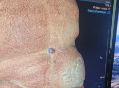 Огромную грыжу удалили воронежские врачи у 79-летнего мужчины в БСМП №8