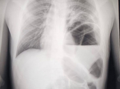 Детей с редким пороком развития прооперировали в воронежской больнице