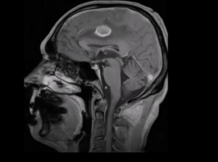 Мужчину с глубокой опухолью в центре мозга спасли воронежские медики