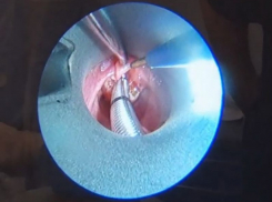 Задыхающуюся малышку спасли врачи Воронежской областной больницы