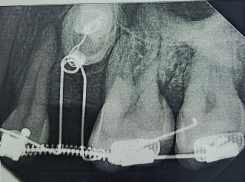 Взрослой пациентке вернули на место непрорезавшиеся зубы в Воронеже