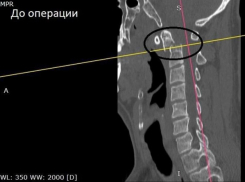 Воронежец упал в подъезде дома и сломал себе шейный позвонок