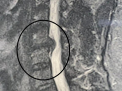 На грани паралича: воронежские нейрохирурги вернули к жизни руку пациента 