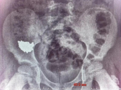 Ребёнок случайно проглотил 20-сантиметровую цепочку – его пришлось оперировать в Воронеже