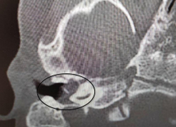 Врачи вылечили редкое заболевание у 2-летней девочки и сохранили ей слух