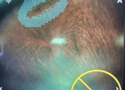 16-летнего белгородского спортсмена с аллергией на анестетики спасли от потери зрения в Воронеже 