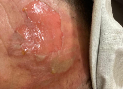 Взрыв мангала на воронежском пляже привел к массовым ожогам