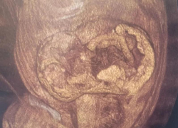 Огромную грыжу вырезали из живота пенсионерки в Воронеже