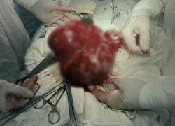 Воронежские врачи удалили пациентке гигантскую опухоль матки размером с ладонь