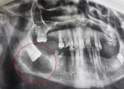 Воронежец много лет ходил с зубом, который рос горизонтально