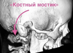Жила в аду 15 лет: воронежские нейрохирурги освободили мозг девушки от костного плена
