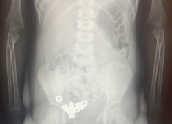 16 гаек проглотил трехлетний ребенок в Воронеже 