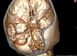 Стрессы на работе довели 35-летнюю женщину до инсульта в Воронеже 
