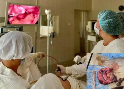 Кисту в 12 сантиметров удалили у женщины воронежские врачи