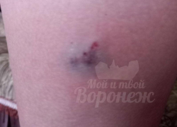 Последствия нападения собаки на 9-летнего мальчика показали в Воронеже