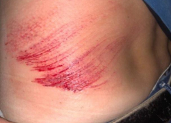 Асфальт поглотил жителя Воронежа, оставив жесткие следы