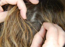 В Воронеже агрессивные вши атаковали детсад