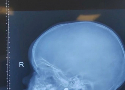 1,5-годовалая малышка едва не задохнулась из-за магнита в Воронеже