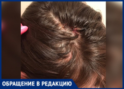 Кроваво-гнойными волдырями покрылась голова девушки после похода в студию красоты в Воронеже