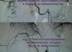 Воронежские врачи удалили из женщины гигантскую опухоль, занимавшую почти всю её печень 