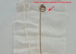 Воронежец полтора года ходил с инородным телом в организме, пока оно не стало частью его тела