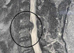 На грани паралича: воронежские нейрохирурги вернули к жизни руку пациента 