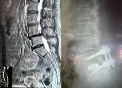 Воронежские медики вернули 61-летней пациентке возможность ходить без боли