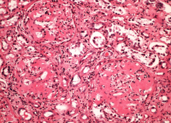 Средиземноморскую лихорадку выявили у воронежского пенсионера