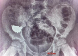 Ребёнок случайно проглотил 20-сантиметровую цепочку – его пришлось оперировать в Воронеже