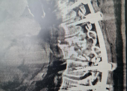 Сломанный позвоночник и угроза инвалидности: как в Воронеже поставили на ноги жертву ДТП