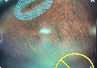 16-летнего белгородского спортсмена с аллергией на анестетики спасли от потери зрения в Воронеже 