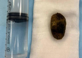 Метод удаления камней с сохранением желчного пузыря применяют в клинике "Доктор Альбрехт"