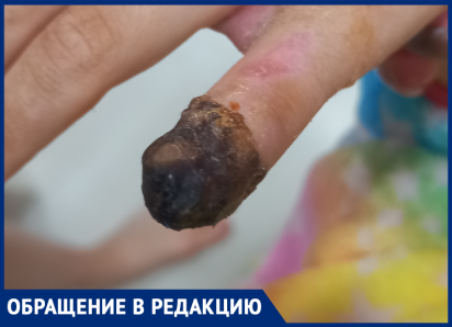  «Девять с половиной пальцев»: девочка лишилась фаланги в Воронеже – кто понесет наказание?