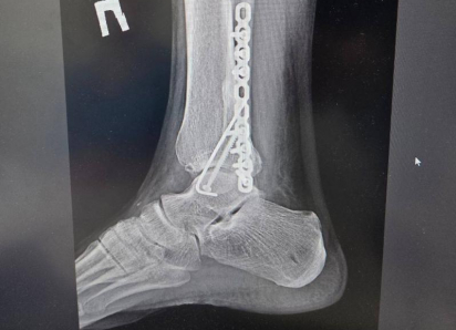 Дело закрыли: воронежец ищет свидетелей ДТП, в котором авто сломало ему ногу