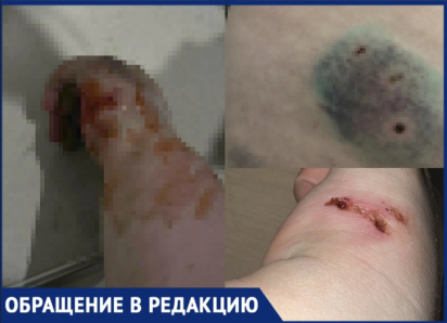 «Я вас всех расстреляю»: беременную девушку искусали псы хозяина с ружьем в Воронежской области